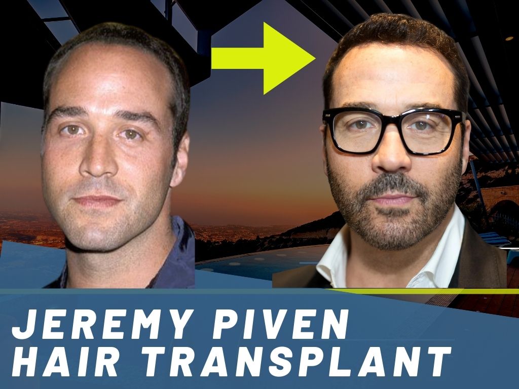 Jeremy Piven Hair Transplant